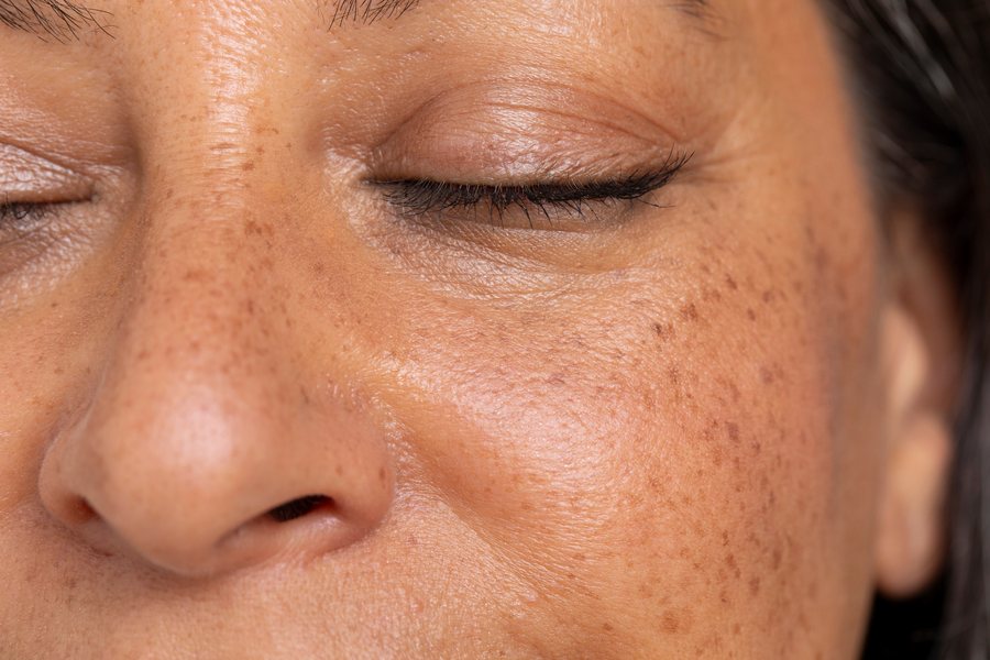 Close-up of a woman with freckled skin and eyes closed